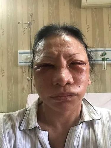 Ratna Sarumpaet diduga babak belur. 