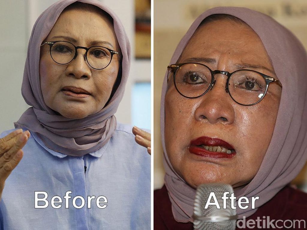Mau Ikutan Ratna Sarumpaet Operasi Plastik? Ini Cara Cari Duitnya Mau Ikutan Ratna Sarumpaet Operasi Plastik? Ini Cara Cari Duitnya