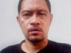 Operasi Plastik, Seniman Agan Harahap Manipulasi Foto Jadi Bonyok