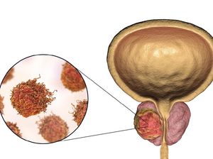 Kanker Prostat: Penyebab, Gejala, dan Cara Mencegah
