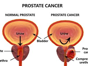 Ada Kanker Prostat dan Pembesaran Prostat, Apa Bedanya?
