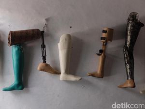 Agar Tidak Infeksi, Begini Caranya Menjaga Kaki Prostetik dengan Benar