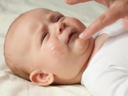 6 Obat Alami untuk Mengatasi Eksem Bayi