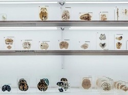 Orang Ini Klaim Sembuh dari Kanker Otak Berkat Diet Keto