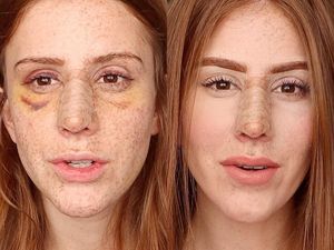 Viral, Selebgram Tampilkan Video Transformasi Hidung Setelah Oplas