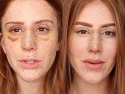 Viral, Selebgram Tampilkan Video Transformasi Hidung Setelah Oplas