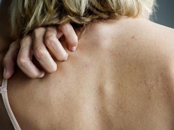 11 Cara Mengobati dan Mencegah Infeksi Jamur Kulit