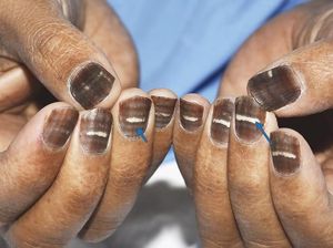 Efek Samping Kemoterapi, Jari Pria Ini Menghitam