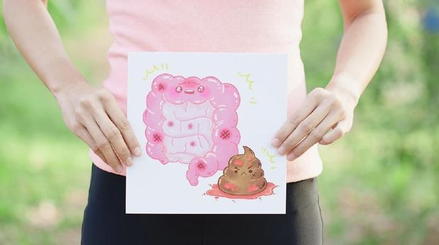 4 Fakta Kanker Usus Seperti Diidap Titi Qadarsih, Bunda Perlu Tahu