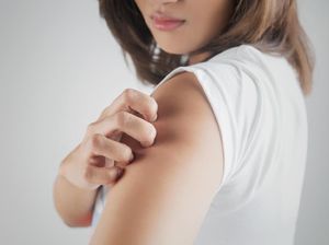 Waspada! Vitiligo Bisa Berkaitan dengan Depresi