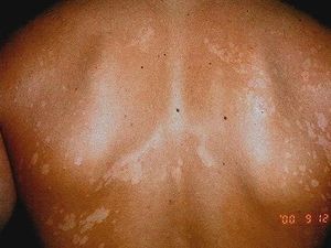 7 Macam Bercak Putih di Kulit yang Ternyata Panu