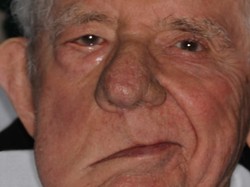 Bells Palsy Adalah Kelumpuhan Otot Wajah, Kenali Penyebab dan Pengobatannya