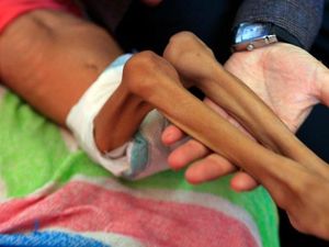 PBB Catat 7 Juta Anak-anak Yaman Alami Kelaparan