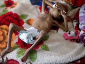 Potret Mengenaskan Anak-anak Yaman Akibat Konflik Berkepanjangan