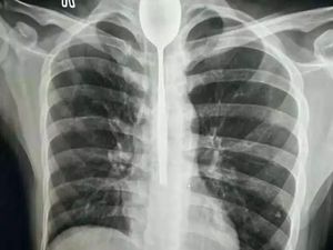 Telan Sendok Demi Taruhan, Sendok Tersangkut di Tenggorokan Selama Setahun