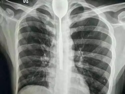 Tega! Pria Ini Dipaksa Telan 63 Sendok Saat di Panti Rehabilitasi