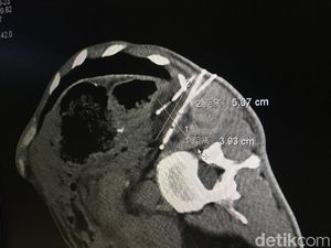 Mau Tau Jenis Kanker Paling Banyak Diidap Orang Indonesia? Ini Daftarnya!