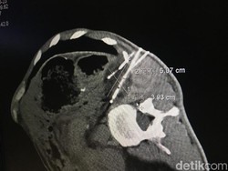 Mau Tau Jenis Kanker Paling Banyak Diidap Orang Indonesia? Ini Daftarnya!