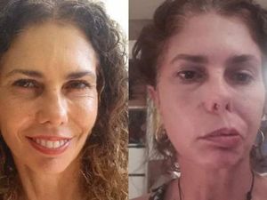 Wajah Perempuan Ini Lumpuh Sebelah Akibat Kutu di Telinga