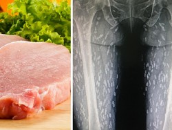 Hobi Makan Daging Mentah, Tubuh Wanita Ini Dipenuhi Cacing