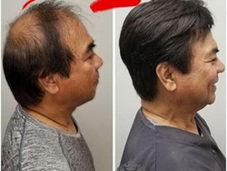 Atasi Rambut Rontok Secara Alami dan Cepat, Ini Caranya!