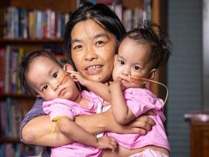 Kembar Siam Asal Bhutan Siap Dioperasi di Melbourne