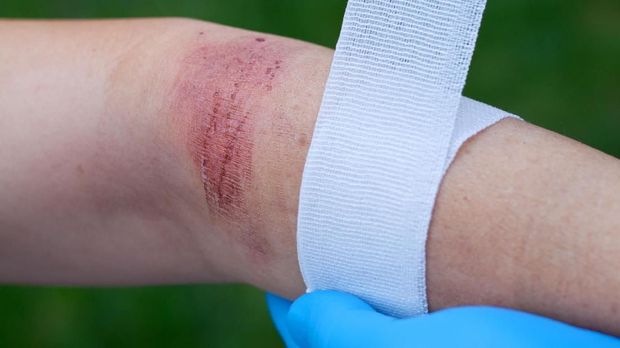 Doctor's hand healing a burned skin area