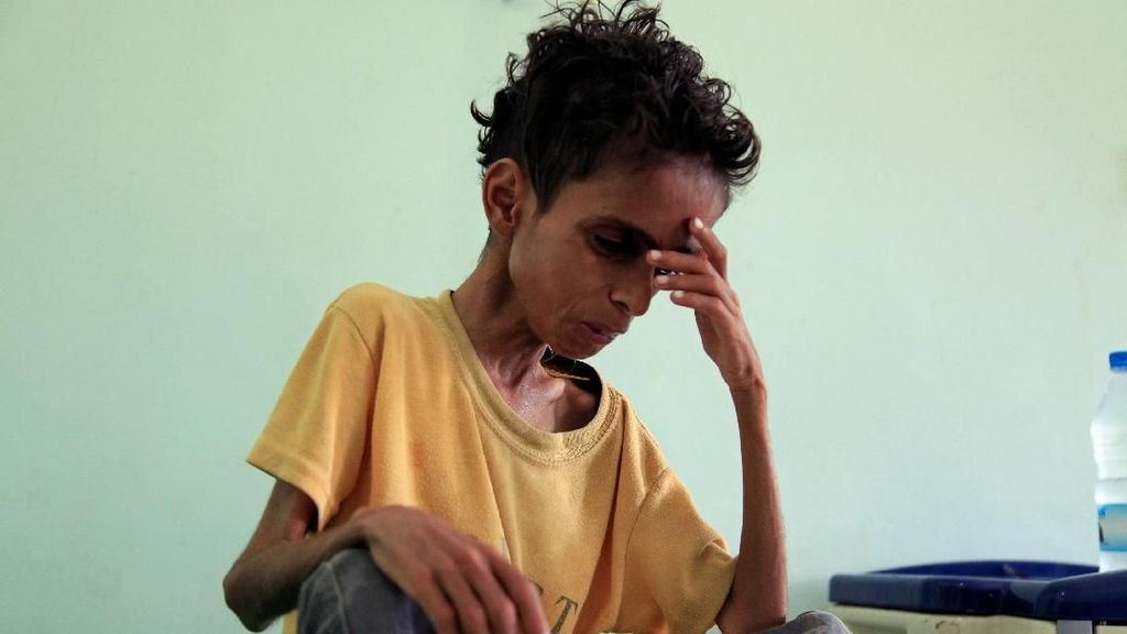 Gizi Buruk Menghantui Kehidupan Anak-anak di Yaman