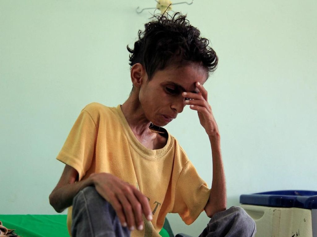Gizi Buruk Menghantui Kehidupan Anak-anak di Yaman Gizi Buruk Menghantui Kehidupan Anak-anak di Yaman