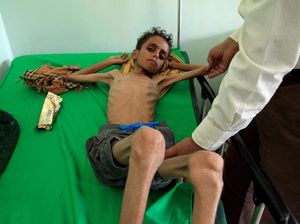Sekjen PBB: Lebih dari 80 Ribu Anak Mati Kelaparan di Yaman