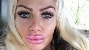 Ngeri! Bibir Wanita Ini Jontor karena Suntik Filler Dicampur Baby Oil