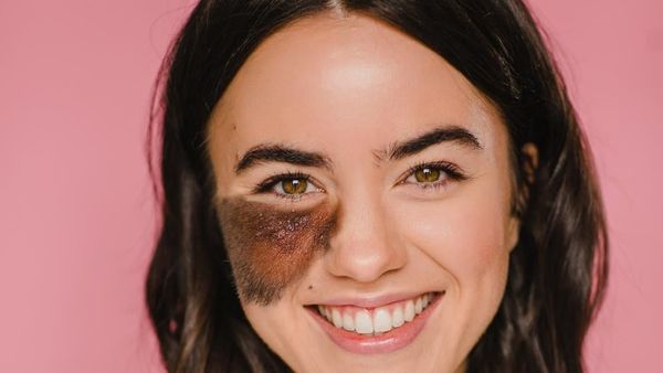 Ada Tompel Berbulu di Wajah, Kecantikan Wanita Ini Viral dan Menginspirasi