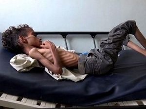 Kondisi Pilu Bocah Yaman Umur 10 Tahun yang Beratnya Hanya 8 Kg