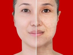 Cara Menghilangkan Jerawat di Wajah dalam Satu Minggu