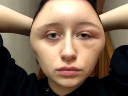 Kepala Wanita Ini Bengkak Seperti Balon Gara-Gara Warnai Rambut