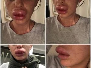 Bibir Wanita Ini Jontor dan Hampir Diamputasi Karena Filler