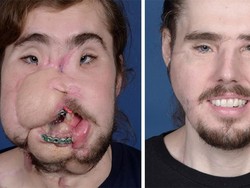 Wajahnya Hancur, Pria Ini Bisa Tersenyum Lagi Berkat Transplantasi