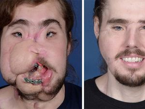 Wajahnya Hancur, Pria Ini Bisa Tersenyum Lagi Berkat Transplantasi Wajahnya Hancur, Pria Ini Bisa Tersenyum Lagi Berkat Transplantasi
