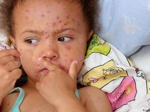 WHO: 110.000 Orang Meninggal Akibat Campak dan Rubella WHO: 110.000 Orang Meninggal Akibat Campak dan Rubella