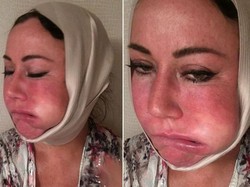 Ngeri, Wajah Wanita Ini Bengkak Sebelah Setelah Operasi Plastik