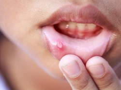 7 Obat Alami untuk Mengatasi Sariawan Si Kecil
