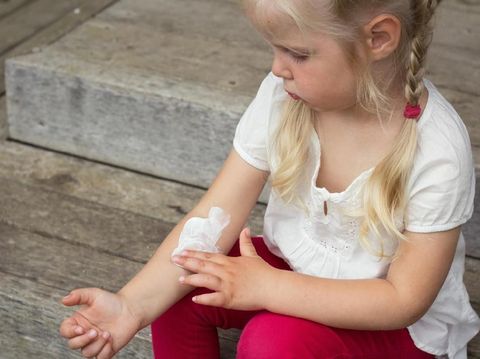 Girl applying dermatology cream on skin, eczema and skin allergy treatment.