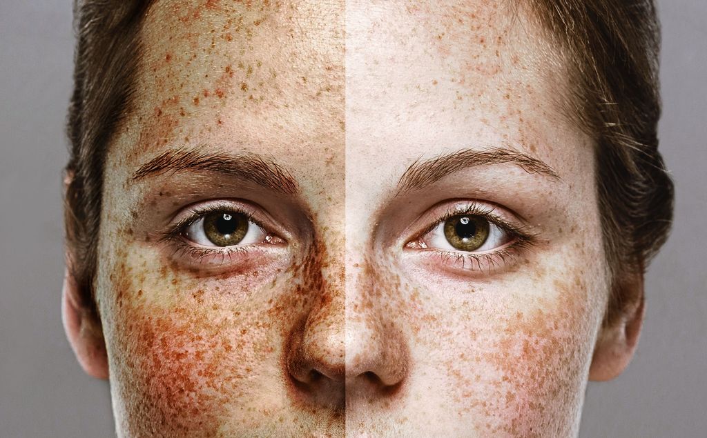 Eyes Woman freckle happy young beautiful portrait with healthy skin half. Studio shot.