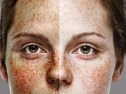 Viral, Foto Wanita yang Jadi Bukti Pentingnya Pakai Pelembap dan Sunscreen