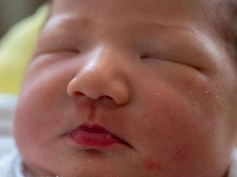 5 Cara Menyembuhkan Jerawat Bayi Agar Tidak Beruntusan