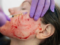 Facial Vampir Disebut Berkaitan dengan Dua Kasus HIV