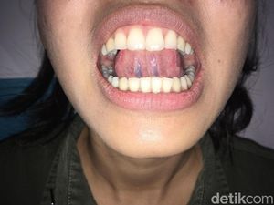 Deteksi Sariawan Biasa atau Kanker Mulut dengan Teknik SAMURI