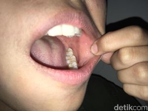 Gejala Baru COVID-19, Studi Temukan Ruam Mulut di Pasien Corona