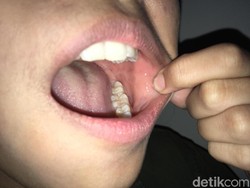 Gejala Baru COVID-19, Studi Temukan Ruam Mulut di Pasien Corona