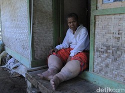 Sakit Kaki Gajah, Warga Sumedang Butuh Pengobatan dan Rutilahu